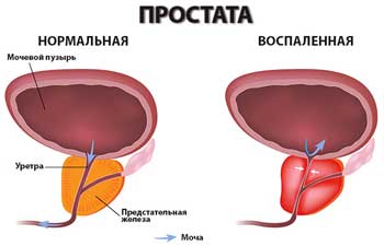Простатиты. Современные подходы к лечению.