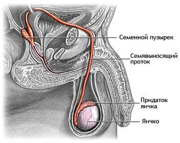 Орхоэпидидимит.